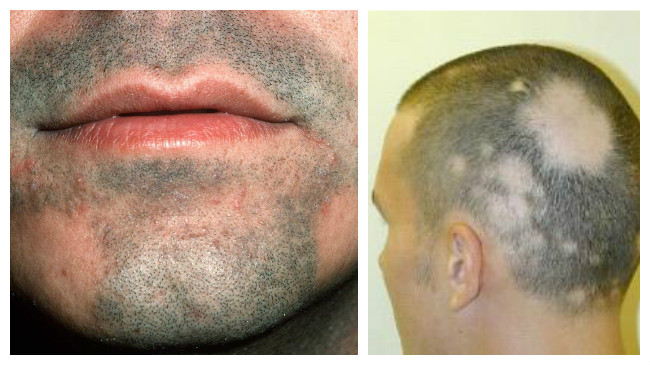 alopecia areata cura definitiva